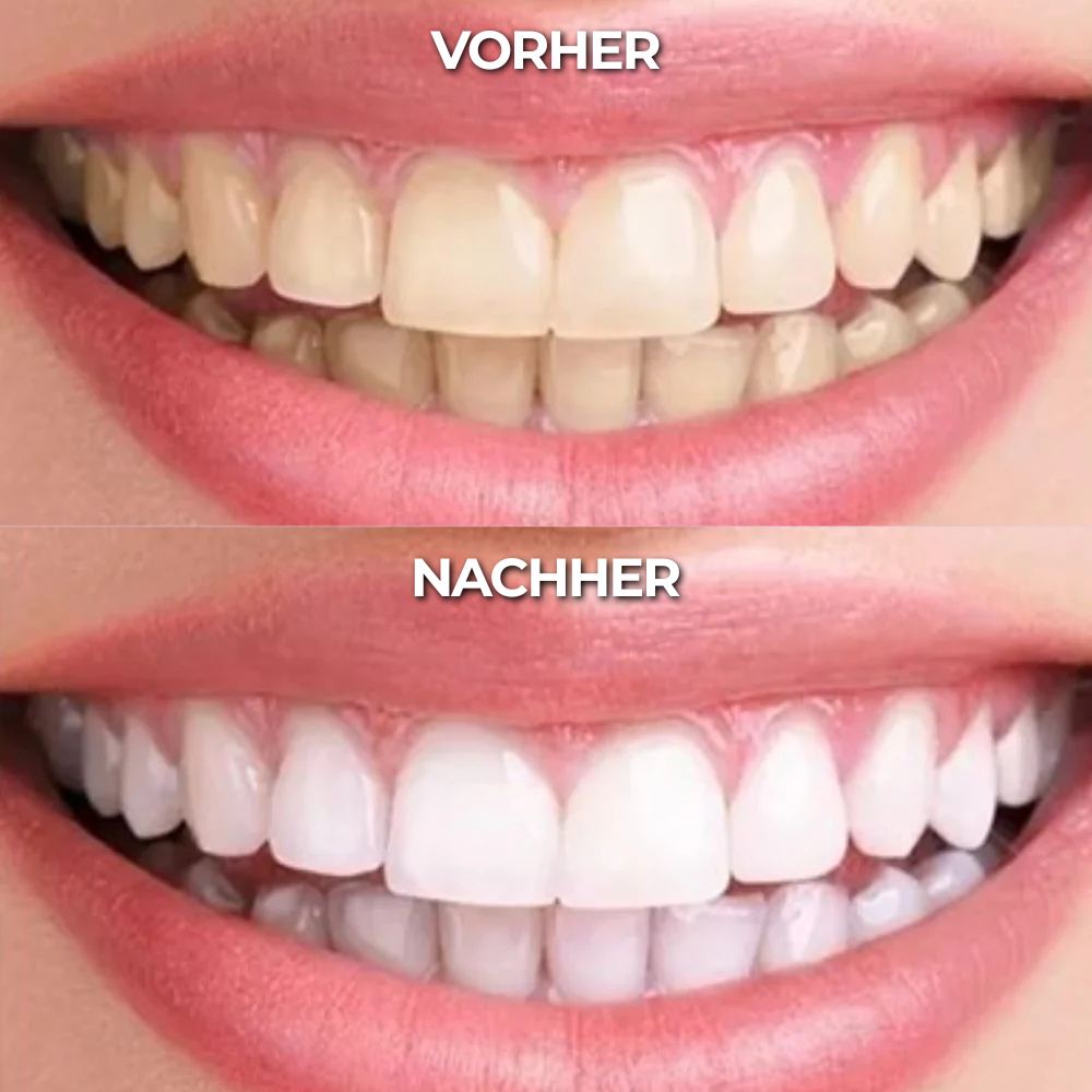Teeth Whitening Gold Serum Pen® – Zahnaufhellungs Stift