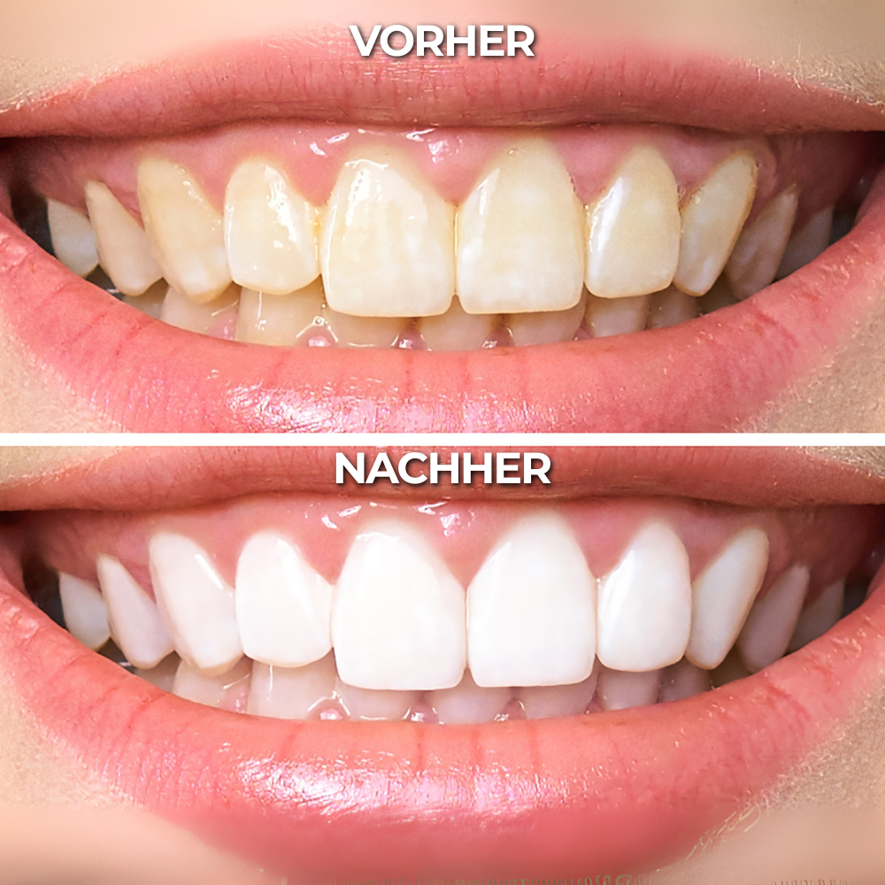Teeth Whitening Gold Serum Pen® – Zahnaufhellungs Stift