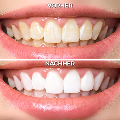 Teeth Whitening Gold Serum Pen® – Zahnaufhellungs Stift