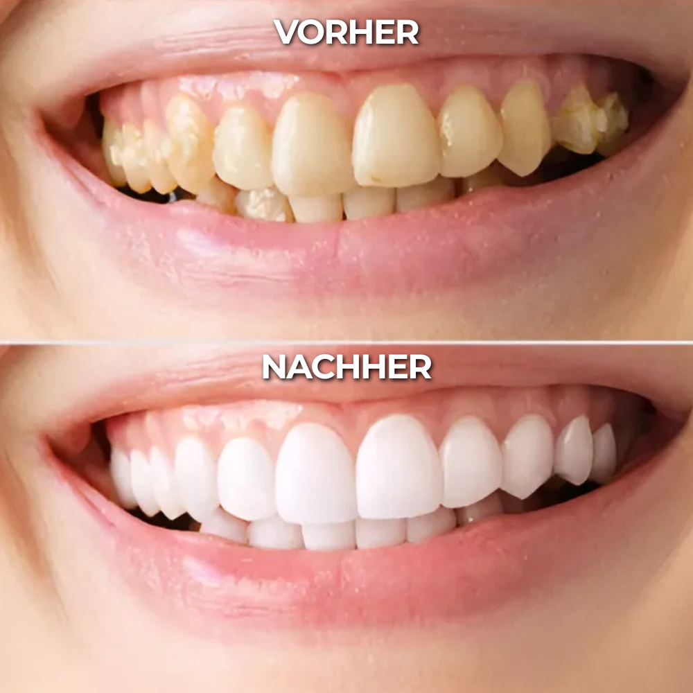 Teeth Whitening Gold Serum Pen® – Zahnaufhellungs Stift